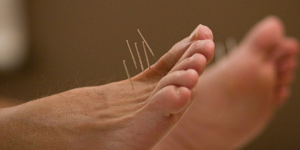 acupuncture-image